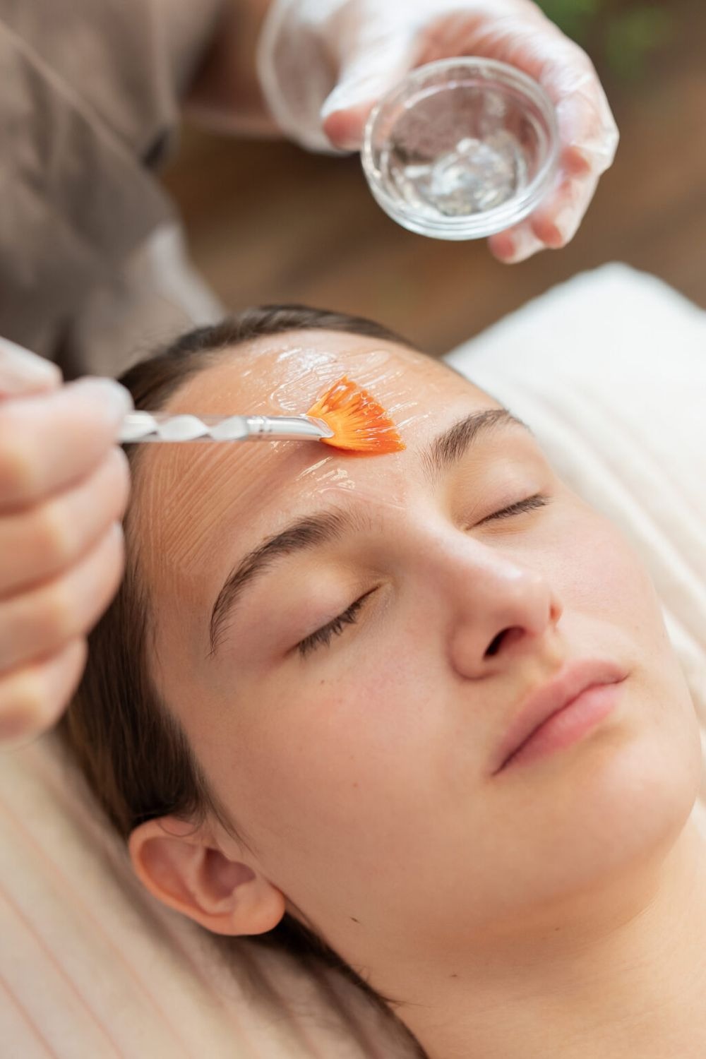 What Are Chemical Peels?